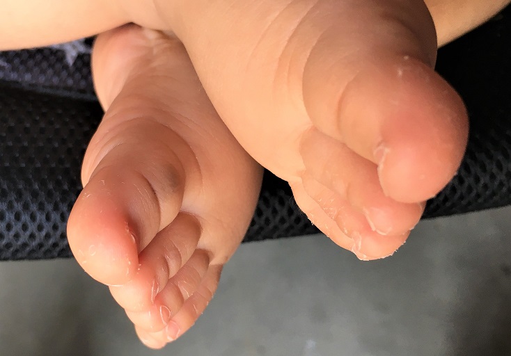 足の指の皮がむけた赤ちゃん