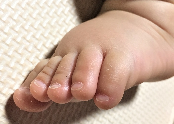 赤ちゃんの足の指の皮がめくれた